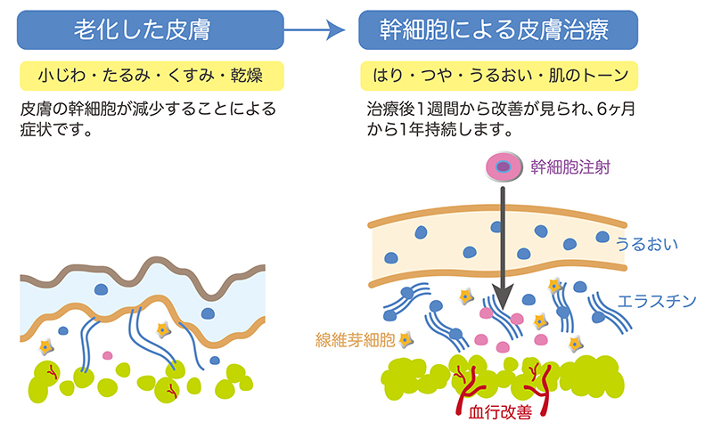 図２．老化した皮膚と幹細胞による皮膚治療