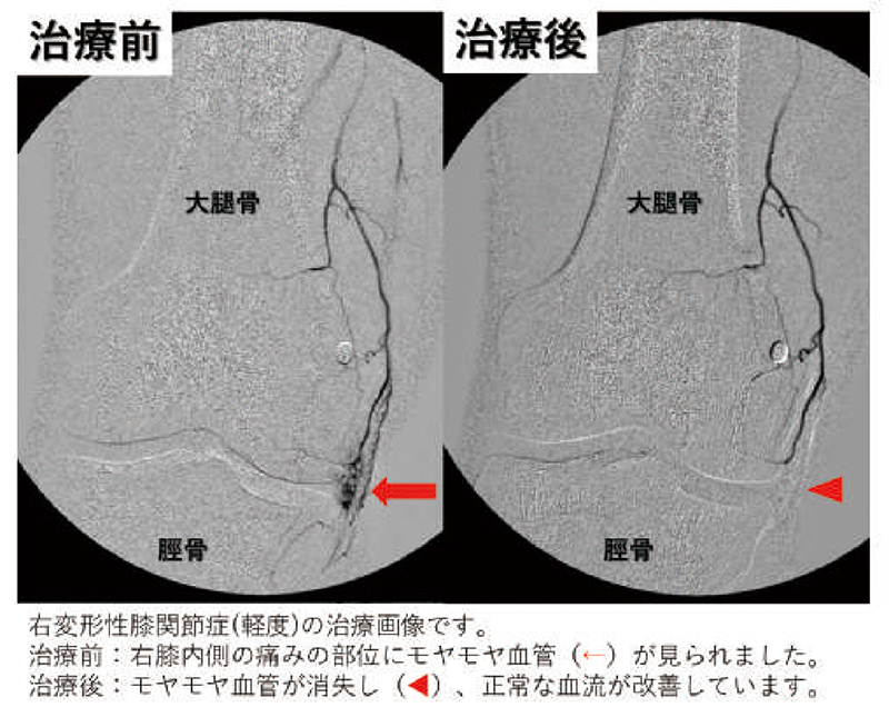 変形性膝関節症（軽度）の治療画像。治療前は痛む部位にモヤモヤ血管（矢印）が見られた。治療後は速やかに消失（矢印）
