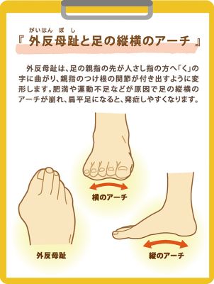 ［沖縄］足のトラブル（１）外反母趾｜身近な病気もっと知ろう 家族の医学手帳（95）