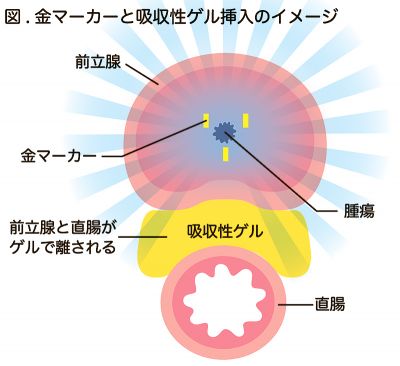 負担が少ない放射線治療｜身近な病気もっと知ろう 家族の医学手帳（123）