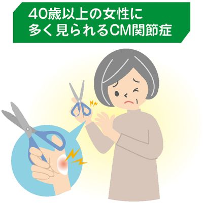 ＣＭ関節症（親指付け根の変形性関節症）｜親指の付け根腫れ、骨が変形［新治療で長引く痛み改善⑫］